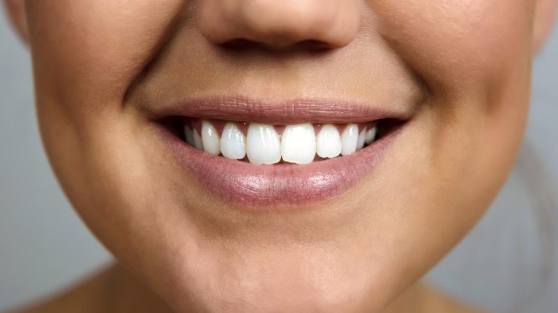 What Is the Lifespan of Dental Fillings?